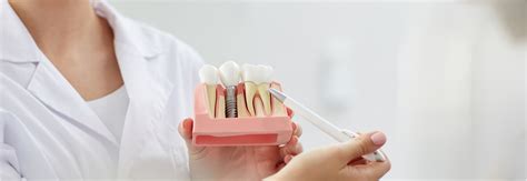 Dental Implants Tooth Club