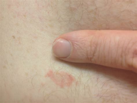 I Have A Small Oval Shaped Rash Around My Abdomen On My Right Side It Is About One Inch And