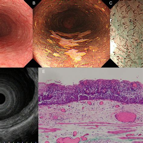 A Patient With Superficial Esophageal Squamous Cell Carcinoma Limited Download Scientific