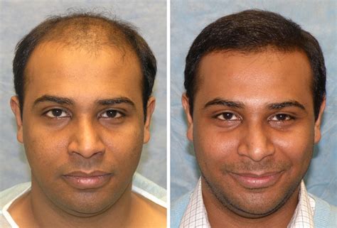 Building Confidence With A Hair Transplant Body Projex
