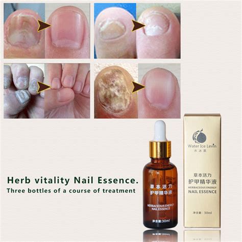 Fungal Nail Treatment Essence Nail And Foot Whitening Oil For Cuticle
