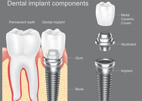 Dental Implant Vs Bridge Which Is Better Dentist For Life