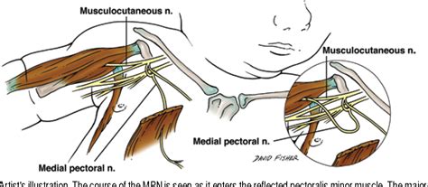 Figure From Medial Pectoral Nerve To Musculocutaneous Nerve Neurotization For The Treatment Of