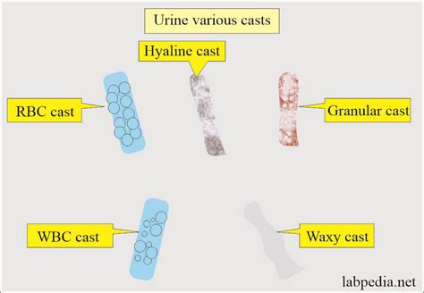 Wbc Casts In Urine