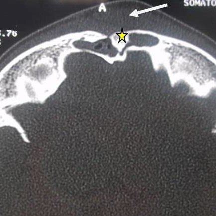 Subperiosteal Abscess Of The Right Anterior Frontal Area Long Arrow