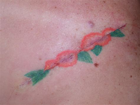 Tattoo Removal Excision The Cosmetic And Skin Surgery Center