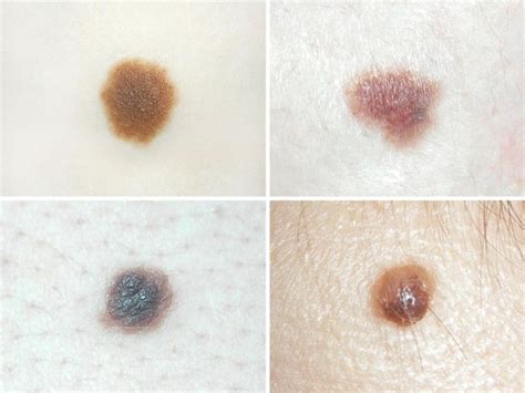 When To Worry About A Mole On Children And Skin Cancer Risks