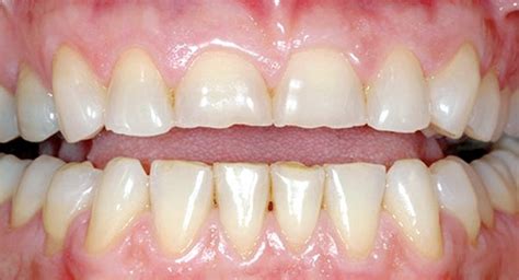 El Desgaste Del Esmalte Dental Causas Y Tratamiento