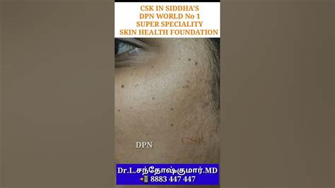Dpn Skin Problem ஆ Dpn Tamil Dpn Face Dots Face Black Dots Face