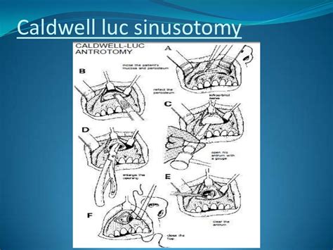 Surgical Anatomy Of Maxillary Sinus Note On 2