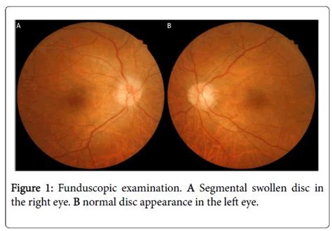 The 25 Best Optical Coherence Tomography Ideas On