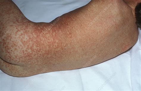 Measles Rash Stock Image M2100258 Science Photo Library