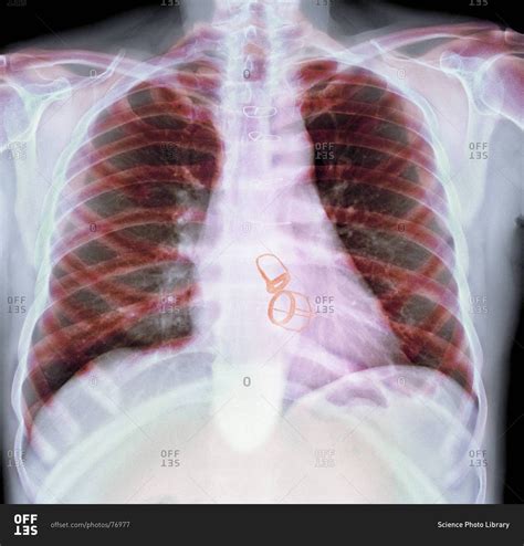 Chest X Ray Of A Patient Showing Their Mitral And Aortic Heart Valves