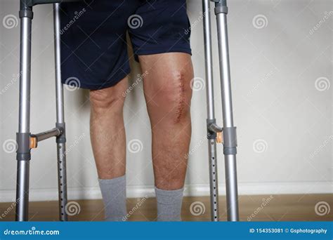 Painful Scar After Knee Surgery Stock Image Image Of Skin Scar