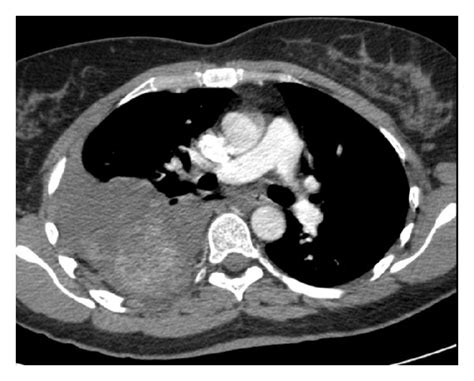 Ct Scan Showing A Right Pleural Effusion Consistent With A Haemothorax