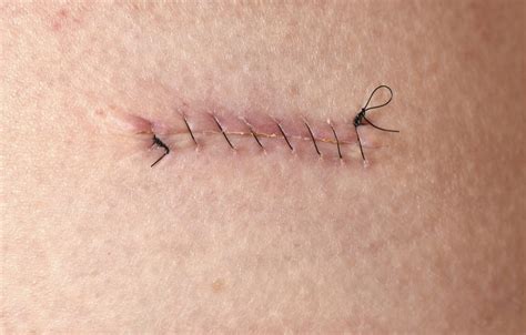 Is Wider Suture Spacing Associated With Better Postsurgical Outcomes