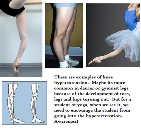 Hyperextended knees can make walking, moving, or exercising painful and slow. PROM - Hyperextended knees | Rexburg Yoga Teacher Reference