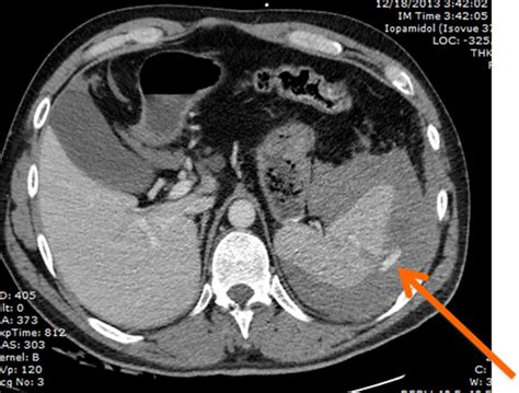 An Update On Nonoperative Management Of The Spleen In Adults Trauma