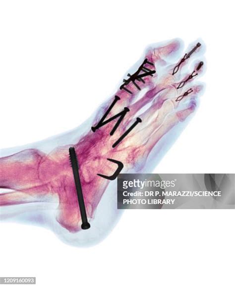 Rheumatoid Arthritis Feet Photos And Premium High Res Pictures Getty