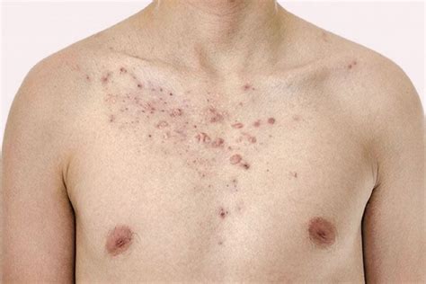 Chest Acne Causes Treatment And Prevention