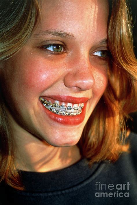 View Of A Girl With Fixed Braces On Her Teeth Photograph By Mark Clarke Science Photo Library