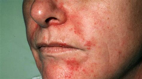 Seborrheic Dermatitis On Face Treatment Symptoms And Pictures