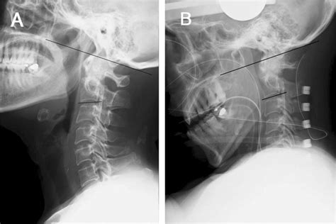 Cervical Lateral Radiographs Showing The O C2 Angle Black Lines A