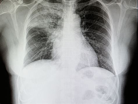 Breast cancer isn't what it was 20 years ago. Lung cancer X-rays fail to detect almost a quarter of cases