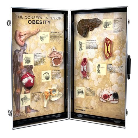 Obesity Health Consequences 3 D Display Health Edco