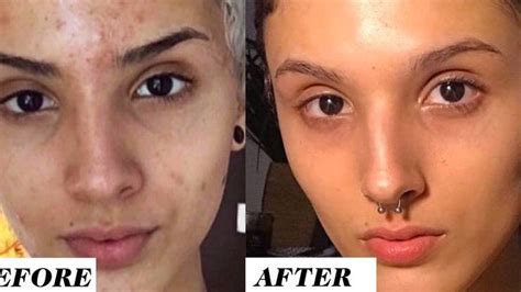 This Womans Before And After Retinol Results Are Going Viral On Reddit