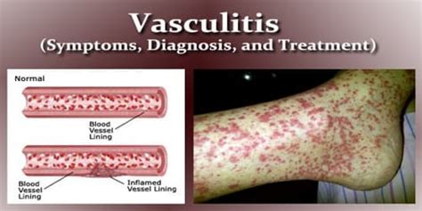 Vasculitis Symptoms Diagnosis And Treatment Zoefact