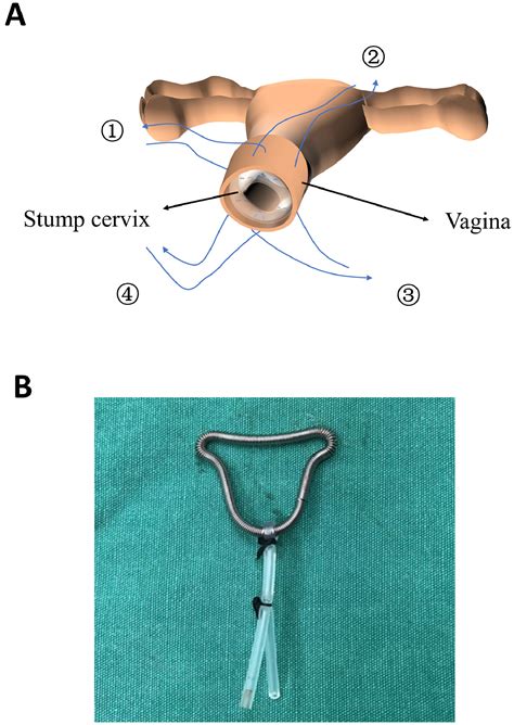 Feasibility Of The Cuff Sleeve Suture Method For Functional Neocervix