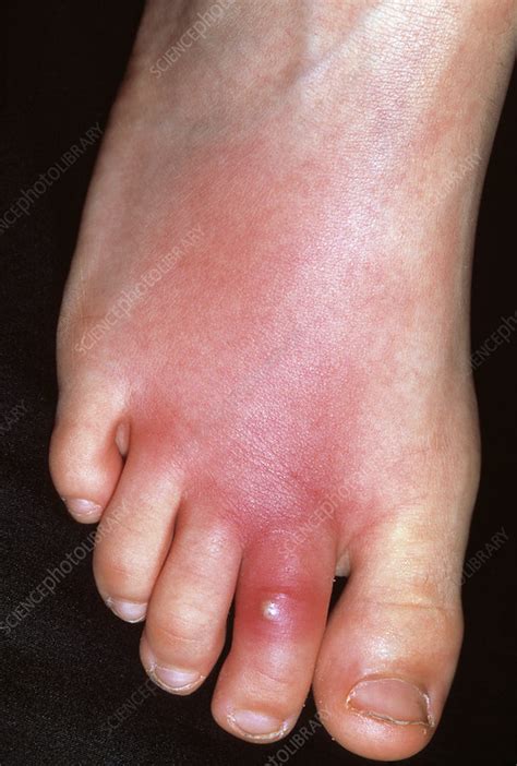 Cellulitis Stock Image M1300596 Science Photo Library