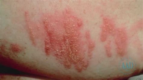 How To Tell If A Rash Needs Medical Attention Dry Hair Care Skin