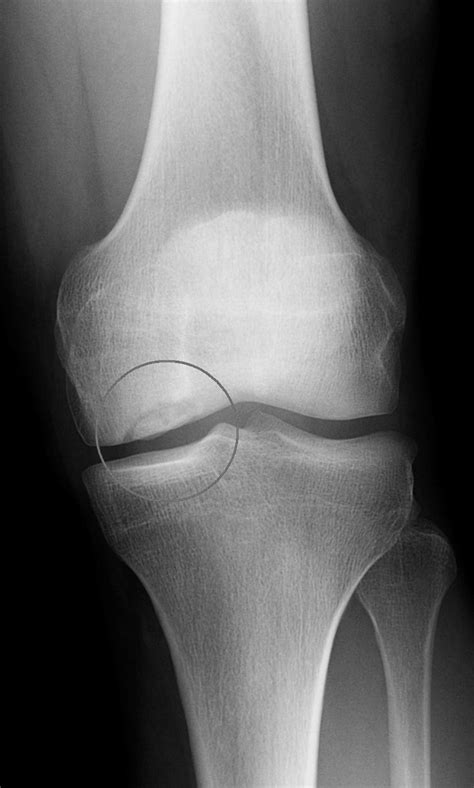 Anteroposterior radiograph of knee with a medial femoral ...
