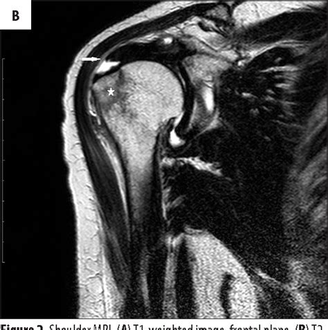 Figure 2 From Magnetic Resonance Imaging Of Rotator Cuff Tears In
