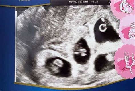 Utama » kehamilan » ingin hamil » tanda awal anda mungkin hamil. Hamil Kembar 4 Selepas Jalani IUI, Wanita Ini Kongsi ...