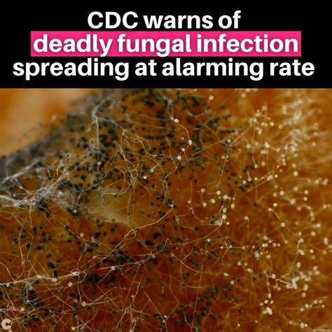 Cdc Warns Of Deadly Fungus Infection Spreading At Alarming Rate Cases