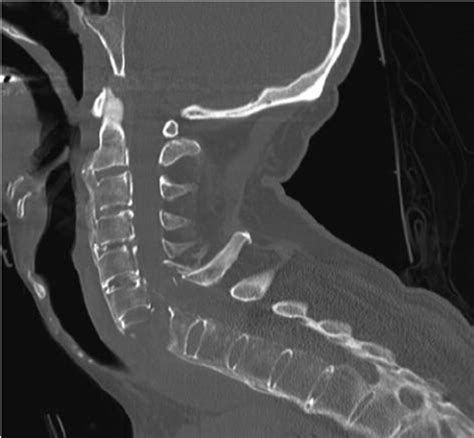 Plain Radiograph Lateral View Of The Cervical Spine Fracture