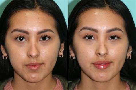 Lip Augmentation Photos Chevy Chase Md Patient 21600