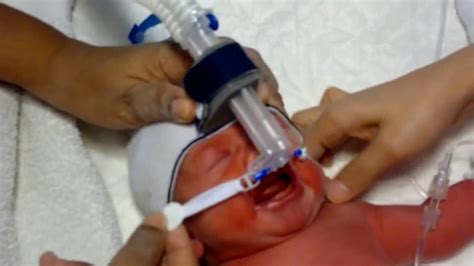 Attachment Of Bubble Nasal Cpap On A Newborn Youtube