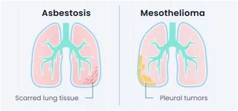 Asbestosis Causes Symptoms And Treatment Options