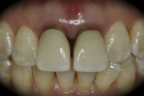 Central Incisors Dentistry And Practices