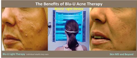 Blu U Therapy For Acne In Plano Tx Acne Treatment Frisco Tx
