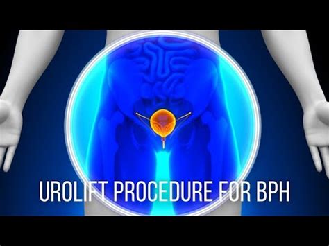 UroLift Procedure For BPH Dr David Harris YouTube