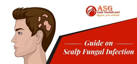 Fungal Scalp Infection Or Tinea Capitis How To Identify 44 Off