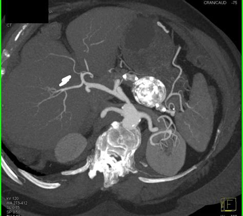 Calcified Splenic Artery Aneurysm Spleen Case Studies Ctisus Ct
