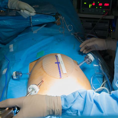 Umbilical Hernia Hernia Laparoscopic Surgery The Most Advanced Centre