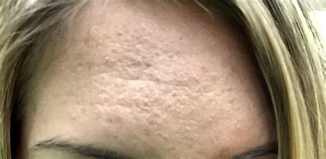 More pores+ active sebaceous glands = oily skin or forehead. Accutane for subclinical acne (forehead bumps ...