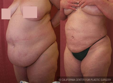 Patient Liposuction Abdomen Plus Size Before And After Photos Beverly Hills Plastic